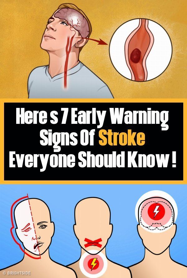 7 Incredibly True Warning Signs Of Stroke ! - HealthMgz - Healthy ...