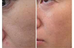 Routine A Suivre Pour Resserrer Les Pores Dilates De La Peau