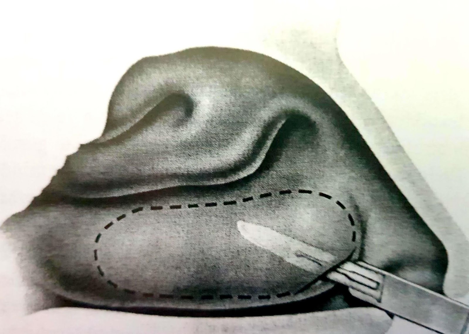 Burun Eti Küçültme Yöntemleri