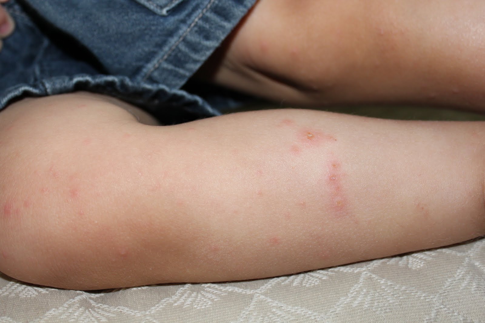 Bubbles & Fun Hand, Foot & Mouth Disease / Strep Throat