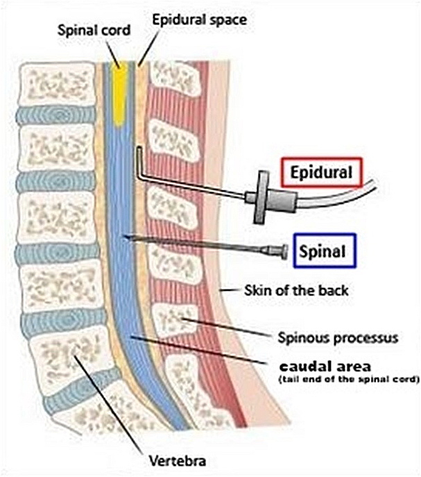 Total Intravenous Anesthesia And Spine Neurosurgery