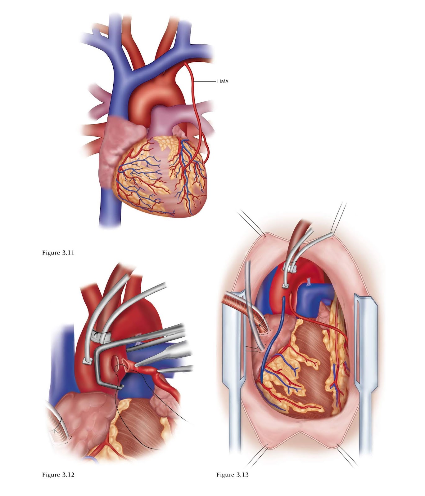 Что такое шунтирование сердца и сосудов. Коронарное шунтирование сосудов сердца. Операция на сердце шунтирование.