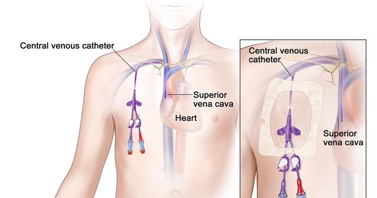 Medicine The Central Venous Catheter Part 7