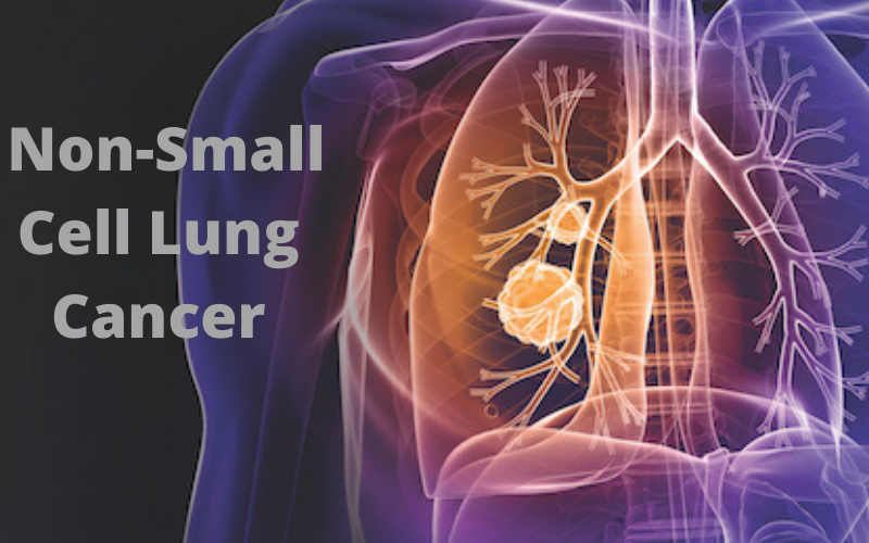 What is NonSmall Cell Lung Cancer? What are the stages of