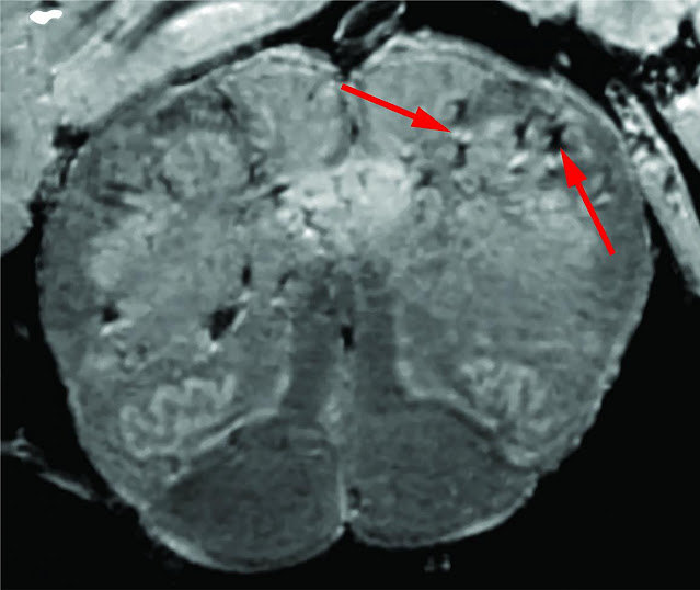 Arrows point to a spot on a scan of a brain.