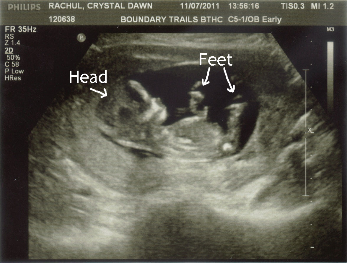 ultrasound-of-13-week-fetal-submited-images