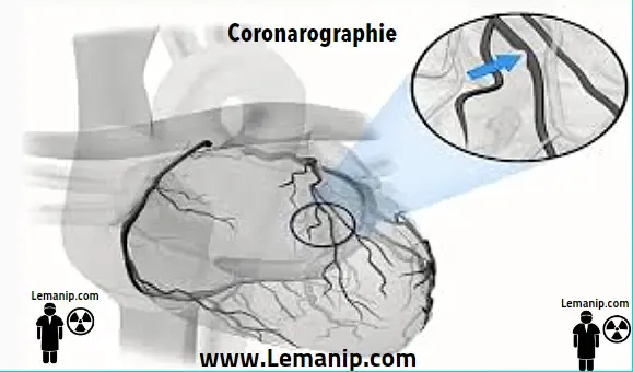 Définition Coronarographie