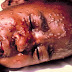 Monkeypox Takes Turn in Nigeria-grgoryhealthworld.com