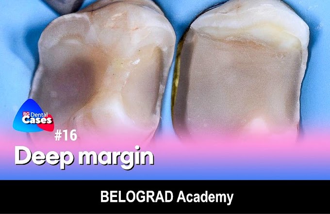COMPOSITE RESTORATION: Deep margin - BELOGRAD Academy