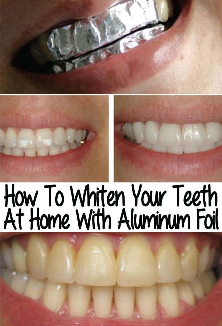 How To Whiten Your Teeth At Home With Aluminum Foil Effective Weight