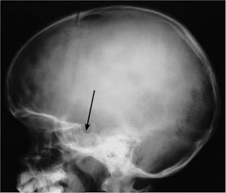 empty sella syndrome