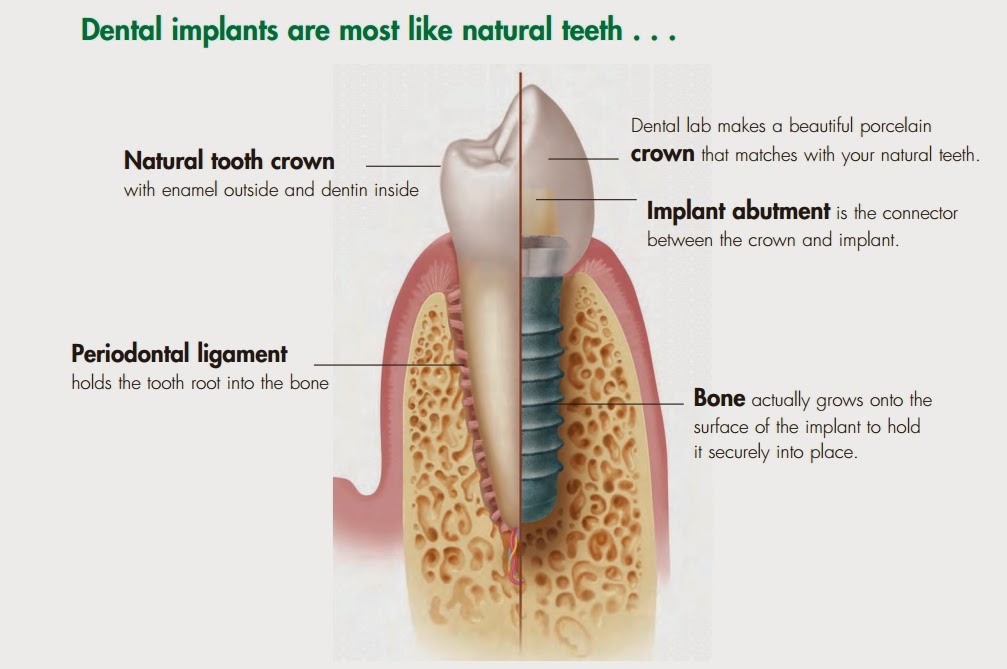 Dental Implant are most like Natural Tooth ....... For more Enquire Consults us......M - +91-78144-51477  www.32gemsdentalclinic.com 