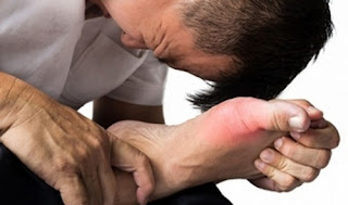 Dấu hiệu bệnh gút ở khớp bàn chân mà bạn nên lưu ý