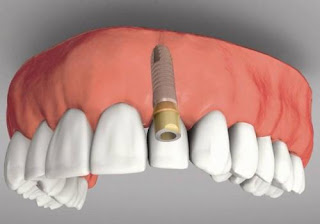 Trồng răng giả có đau không luôn là lo lắng đầu tiên khi thực hiện phục hình răng