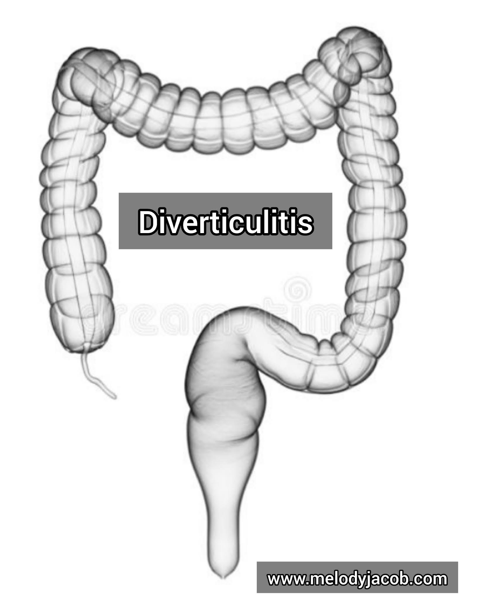 Diverticulitis Symptoms, Causes, Diagnosis, Treatment. Melody Jacob