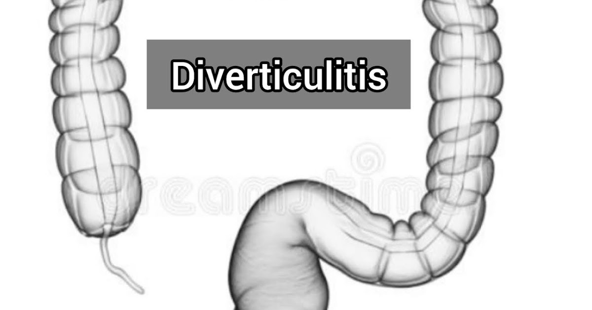 Diverticulitis Symptoms, Causes, Diagnosis, Treatment. Melody Jacob