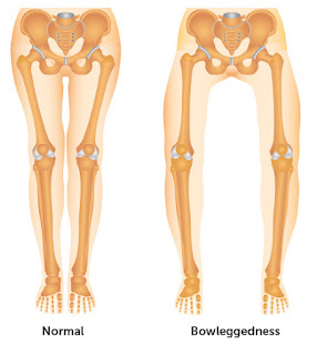 Postural Deformities - Scoliosis, Kyphosis, Lordosis, Knock knees, Flat foot