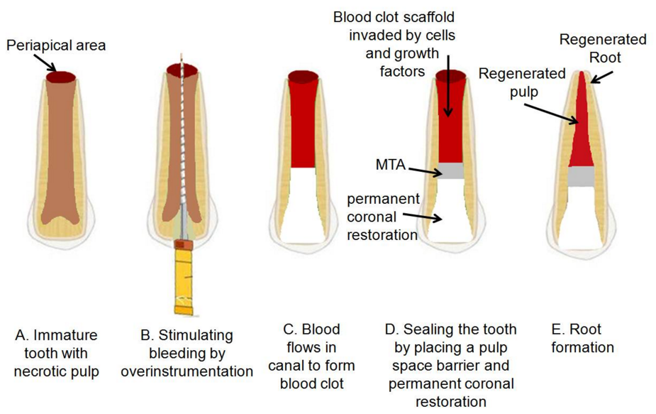 Pulp Revascularization