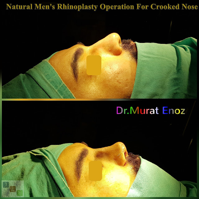 Natural Men's Rhinoplasty Operation For Crooked Nose - Nose Job For Men Istanbul