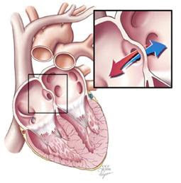 Nursing Assessment Diagnosis Intervention Care Plan for Atrial Septal Defect 