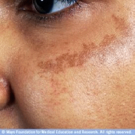 How to Get Rid of Hyperpigmentation? - Lethow