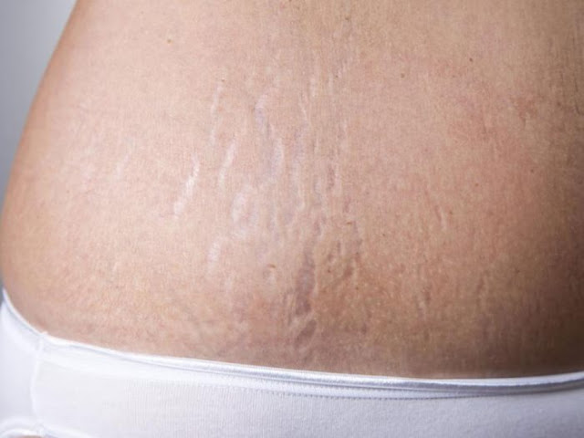 طرق فعالة لعلاج الاسترتش مارك طرق فعالة لعلاج الاسترتش مارك