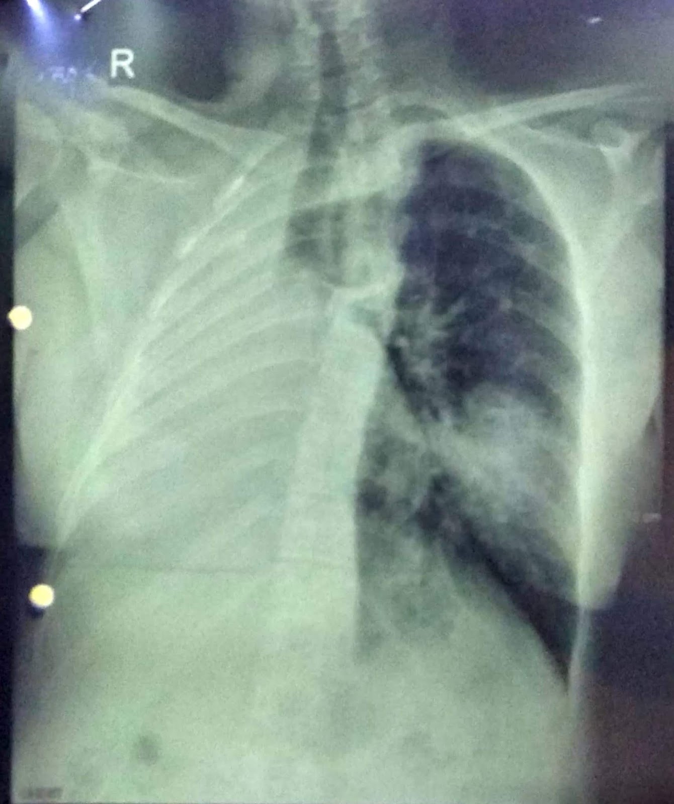 Journal of Postgraduate Gynecology & Obstetrics A Case Of Severe Restrictive Lung Disease In