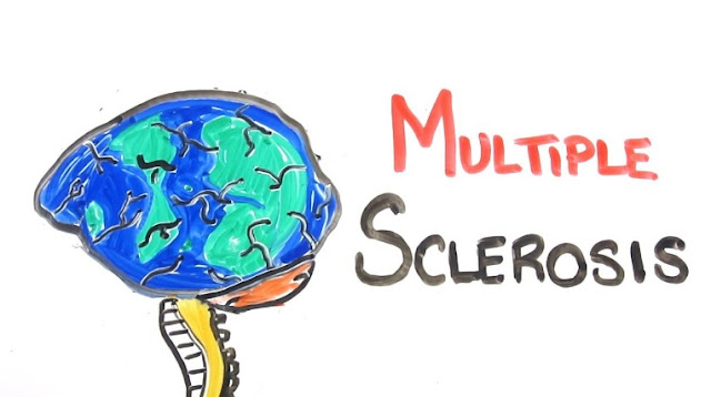 Multiple Sclerosis Symptoms in Females