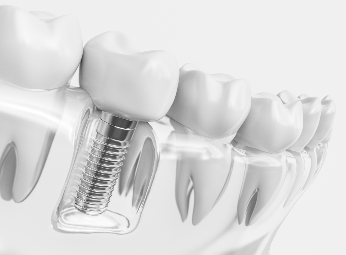 Recovery period for dental implants