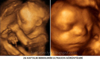 ultrasonda 26. hafta görüntüsü
