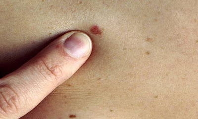 اعراض سرطان الجلد وأنواعه وكيف بمكن اكتشافه بنفسك ؟