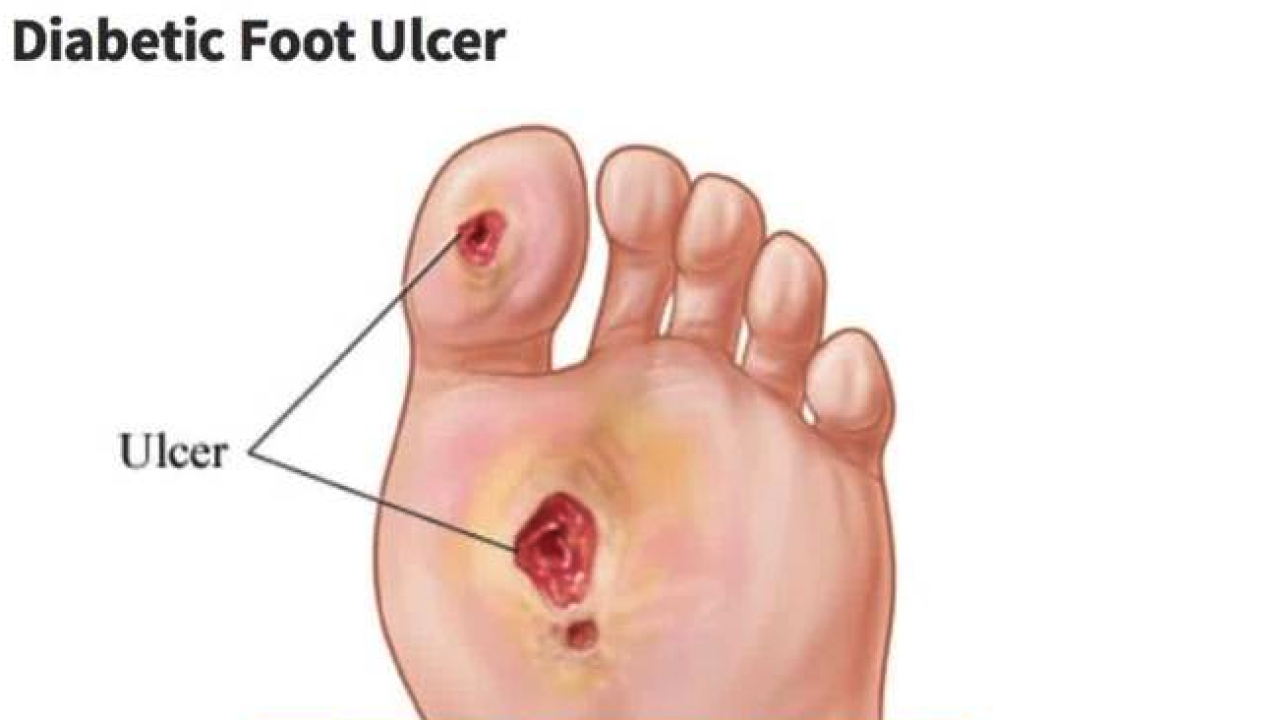 How Does Diabetic Foot Ulcers Start? Diabetes Foot Care
