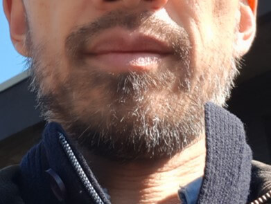 0.4 mm beard
