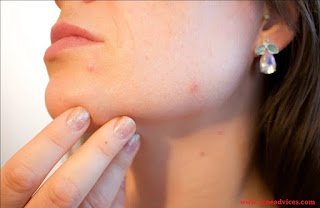 Face-Mapping-of-Acne