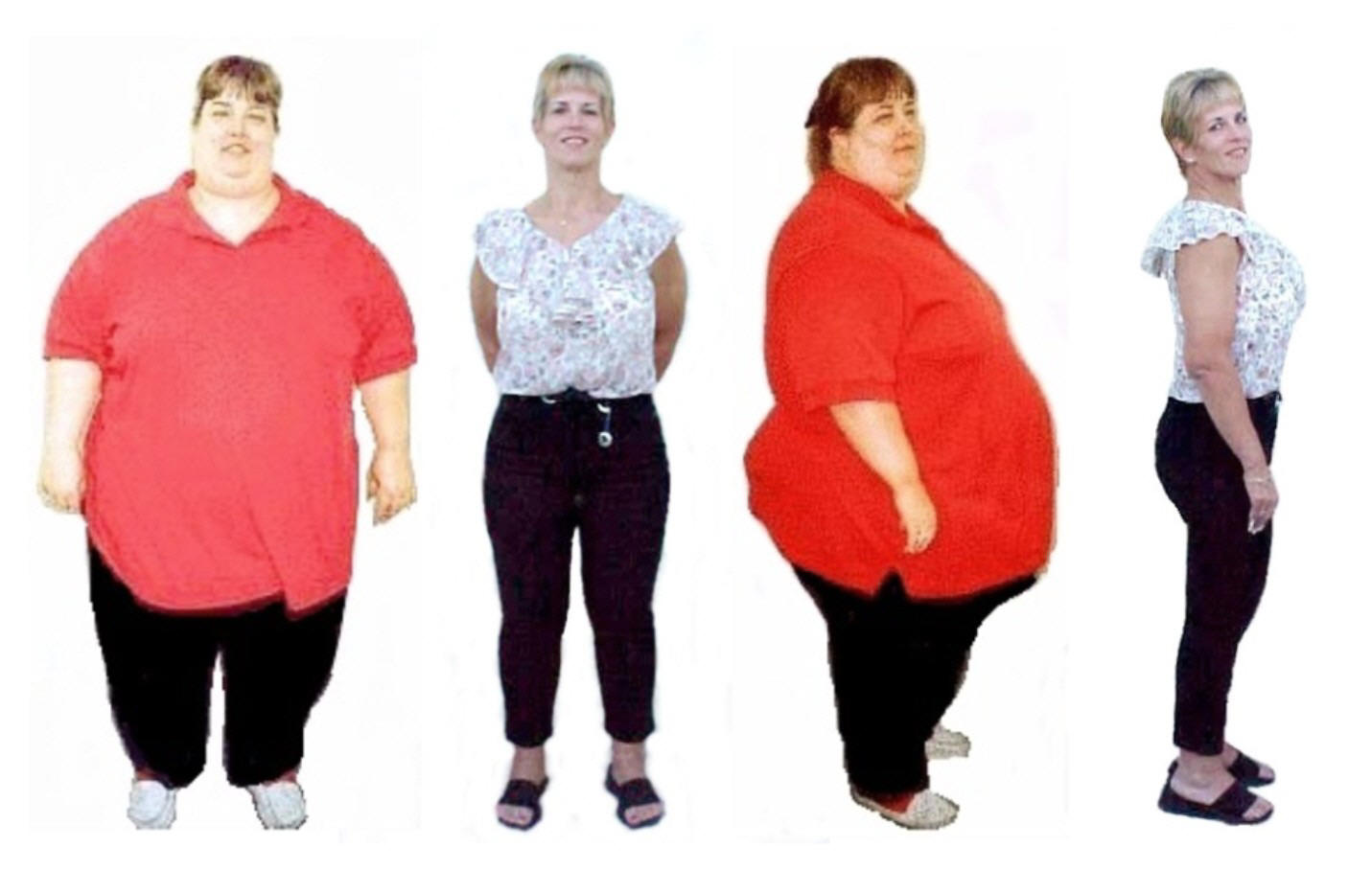 Вес после бариатрической операции. Женский Тип ожирения. Ожирение по женскому типу. Ожирение 1 степени фото.