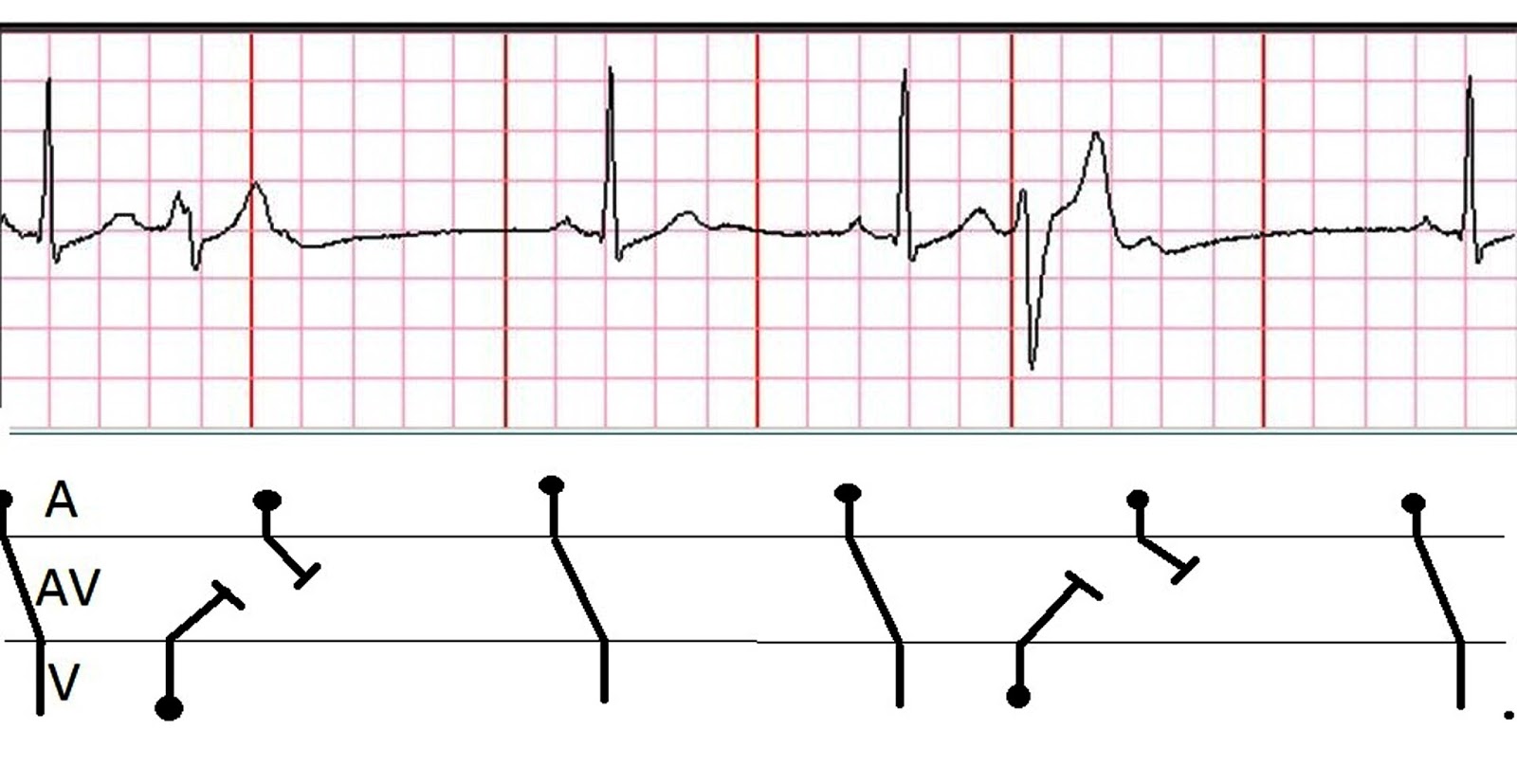 ECG Rhythms Concealed retrograde conduction