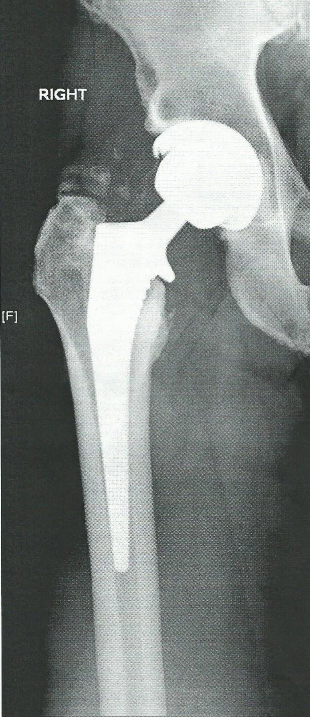 Crazy On Three Titanium Hips Post Op