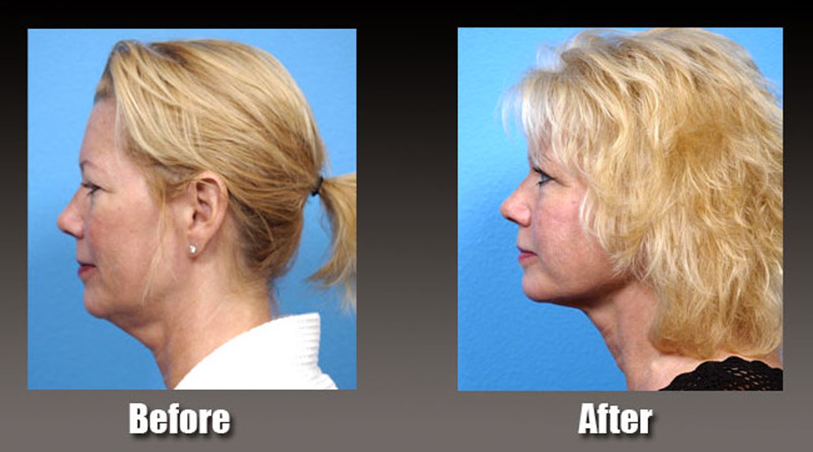 Liposuction Las Vegas