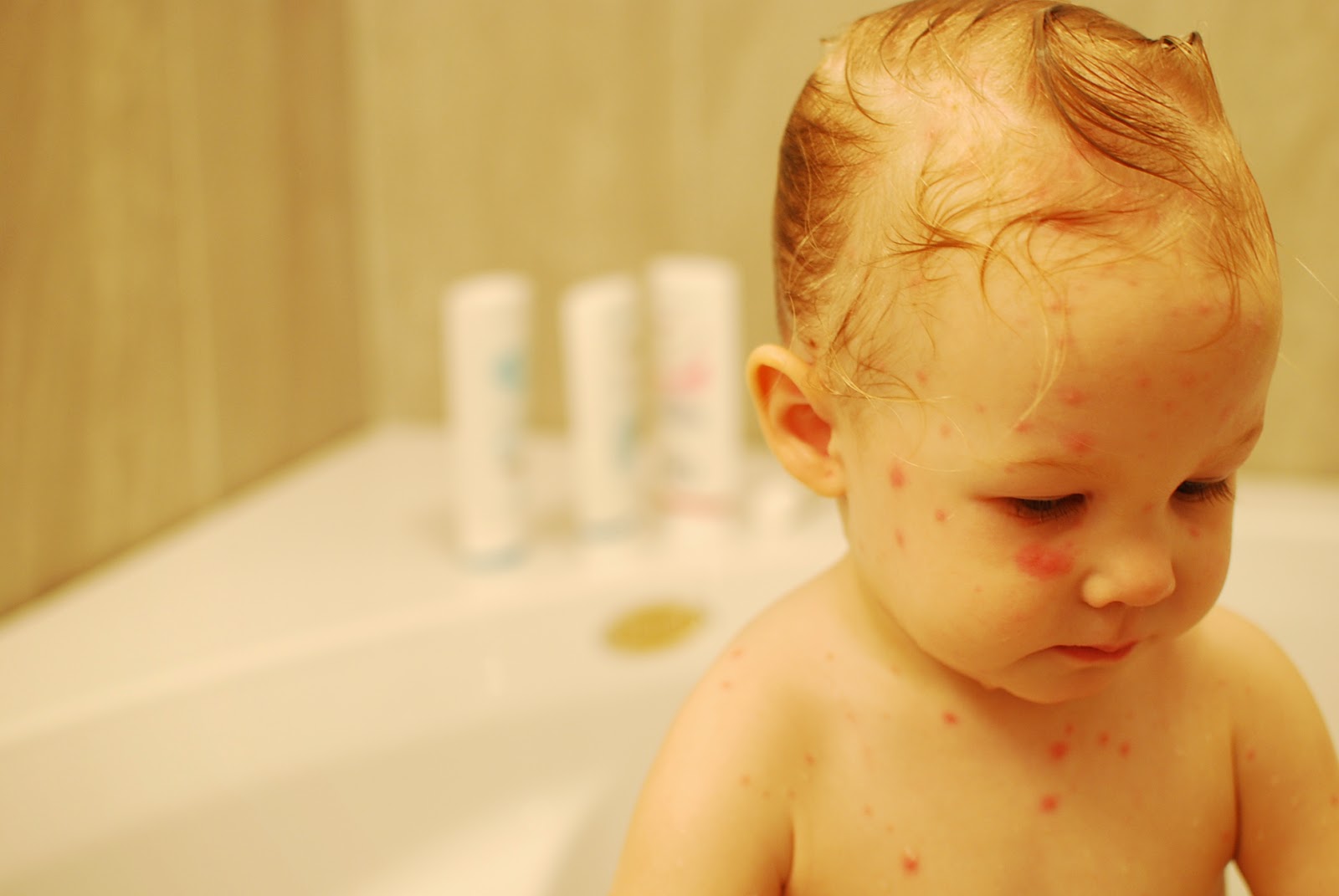 Stand and Deliver Chicken pox?