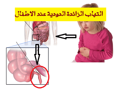 التهاب الزائدة الدودية