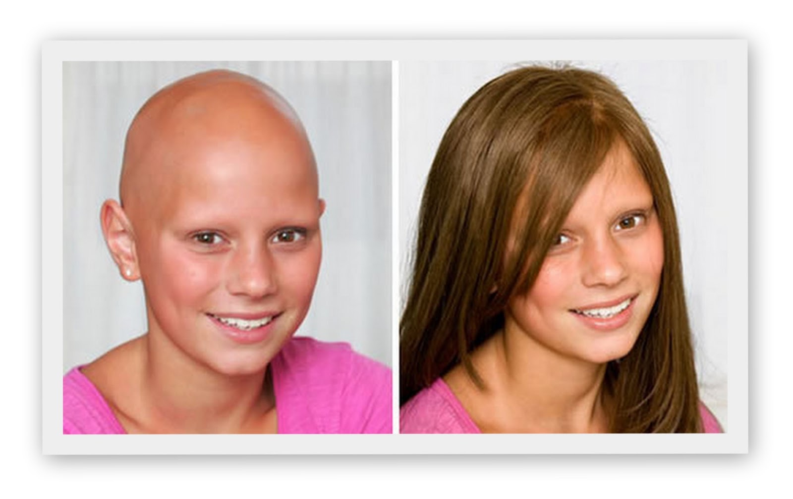 hair loss help Children with Hair Loss Problems