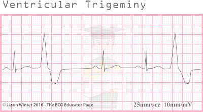 ECG Educator Blog : Ventricular Ectopics