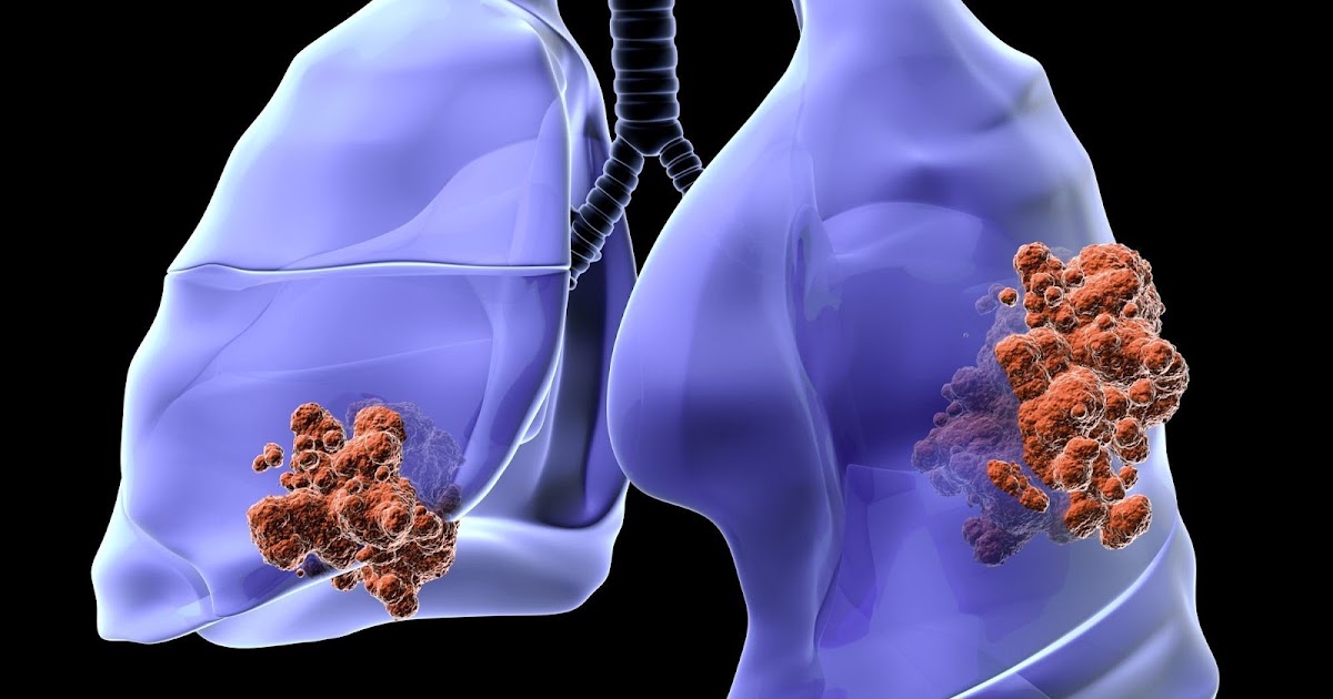 Comment le cancer commence, se développe et se propage Comment le cancer commence, se développe et se propage