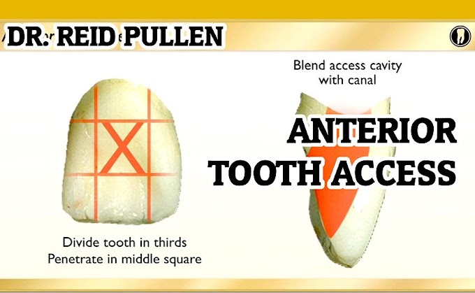 ENDODONTIC: Anterior Tooth Access - Dr. Reid Pullen