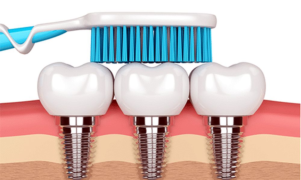 How to Clean Dental Implants Directorio Odontológico