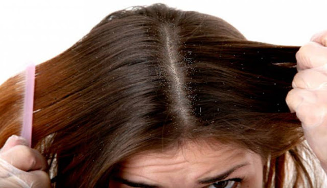 cara menghilangkan kutu rambut, tips ampuh mengusir kutu rambut, cara cepat mematikan kutu rambut, cera menghilangkan ketombe, cara jitu menghilangkan kutu rambut terbaru 2016