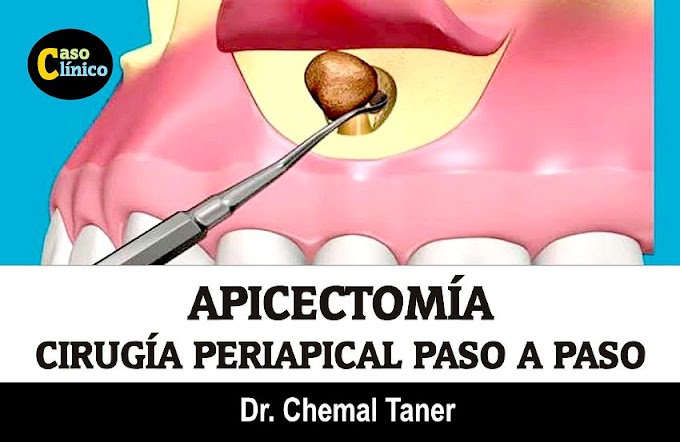 APICECTOMÍA: Cirugía Periapical paso a paso - Dr. Chemal Taner