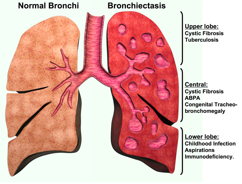 Prepare for Medical Exams : Bronchiectasis - Case Study