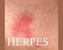 obat herpes