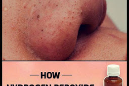 How To Use Hydrogen Peroxide Removes Blackheads?